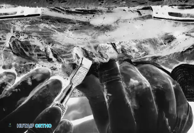 Through midline incision in paraspinal muscles, ribs are outlined for periosteal cut.