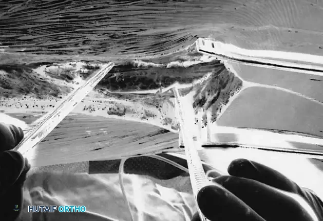 Thoracolumbar fascia is incised off spinous process.