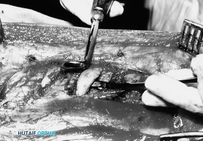 Doyen retractor is passed circumferentially on exposed rib.