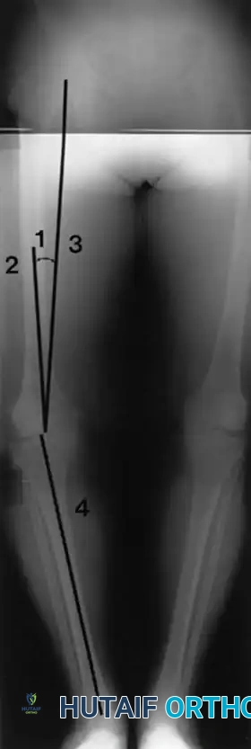 Fig. 6-26 Anatomical and mechanical axes of femur and tibia are determined independently on preoperative long-leg radiographs, with the goal of centering postoperative mechanical axis of limb within center of prosthetic knee. 1, Angle between anatomical (2) and mechanical (3) axes of femur. 4, Mechanical axis of tibia (see text).