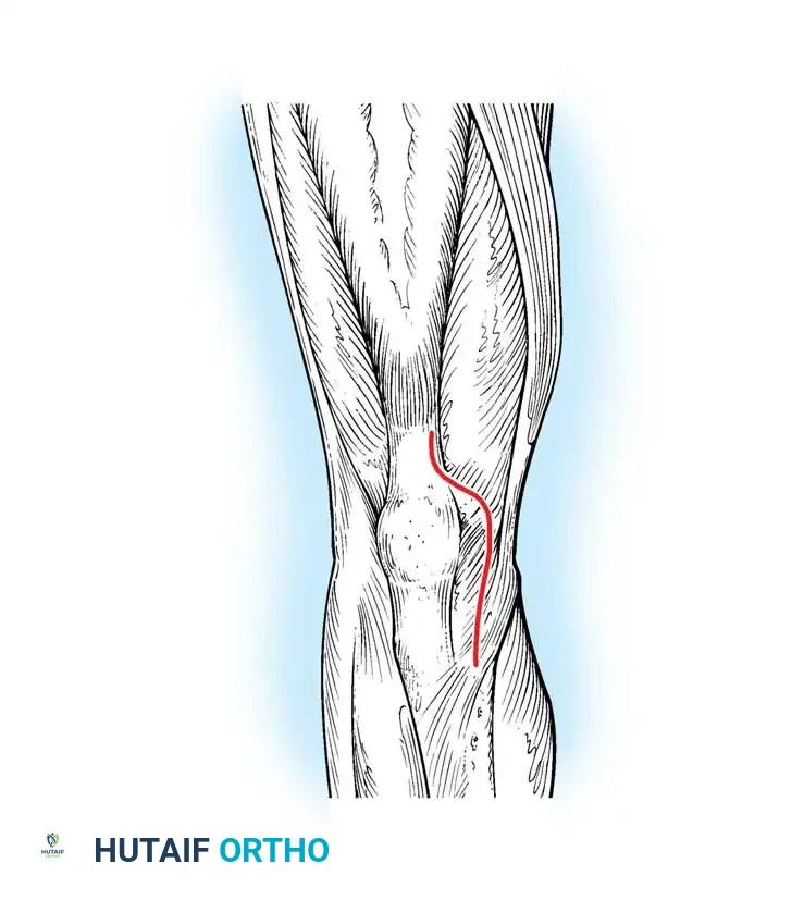 PREOPERATIVE EVALUATION Surgical Diagram