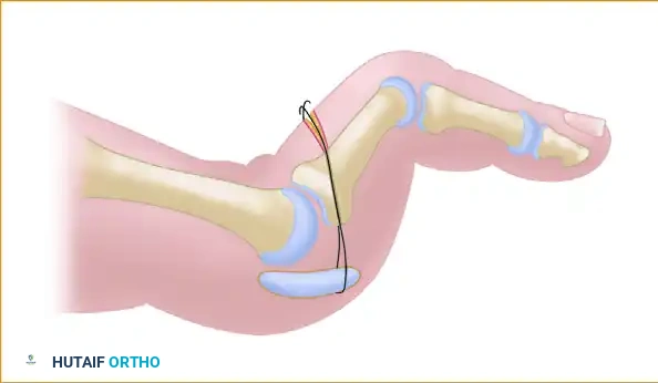 PRIMARY PLANTAR PLATE REPAIR THROUGH A DORSAL APPROACH Surgical Diagram