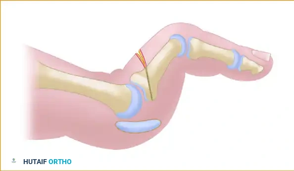 PRIMARY PLANTAR PLATE REPAIR THROUGH A DORSAL APPROACH Surgical Diagram