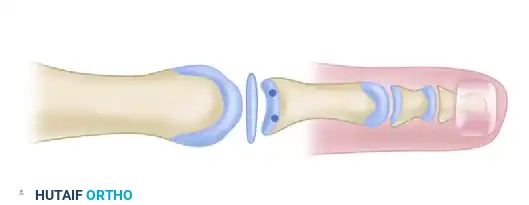 PRIMARY PLANTAR PLATE REPAIR THROUGH A DORSAL APPROACH Surgical Diagram