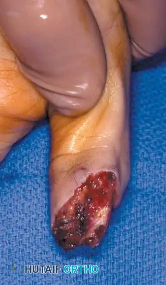 الدليل الشامل لجراحة بتر الأصابع وكيفية ترميمها