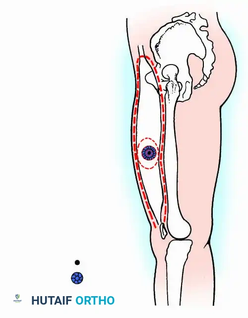 =Tumor =Reactive zone