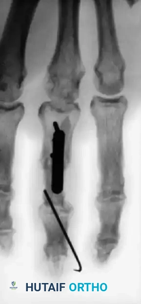 Fig. 64-4 A and B, Open fractures of right hand with loss of distal end of middle phalanx and painful small fi nger partial amputation. C and D, Proximal phalanx of painful and stiff small fi nger was used as structural graft to restore articular column of middle fi nger.