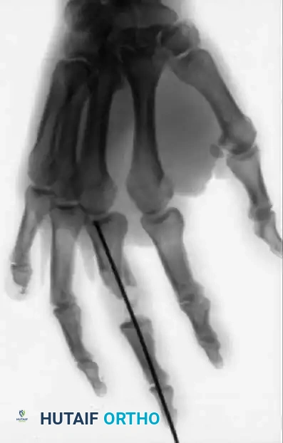 PRINCIPLES OF TREATMENT Surgical Diagram