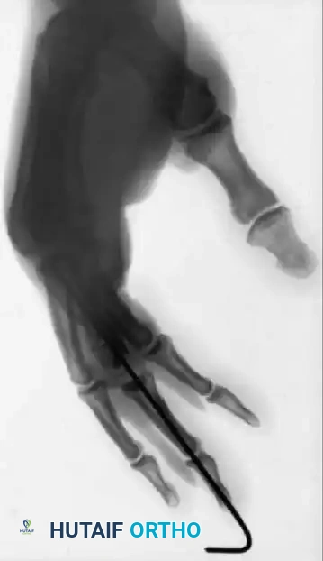 PRINCIPLES OF TREATMENT Surgical Diagram