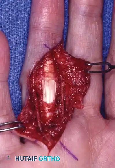 Medial Digital Nerve Displacement