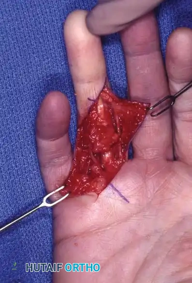 Exposure of the Diseased Cord