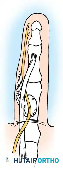Return of Nerve to Normal Position
