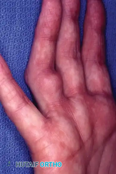 Dupuytren Contracture: Prognosis, Indications, and Surgical Techniques