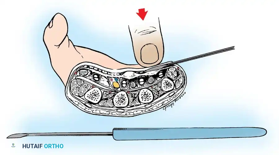 Luck Subcutaneous Fasciotomy Technique