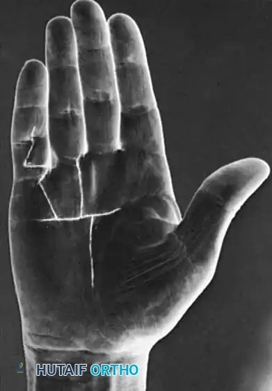 Collagenase Injection Technique