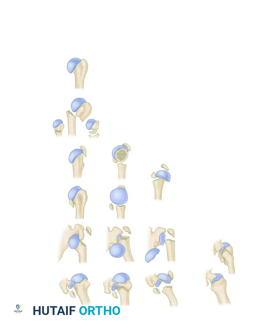 رسم توضيحي لنظام نير لتصنيف كسور أعلى عظمة العضد