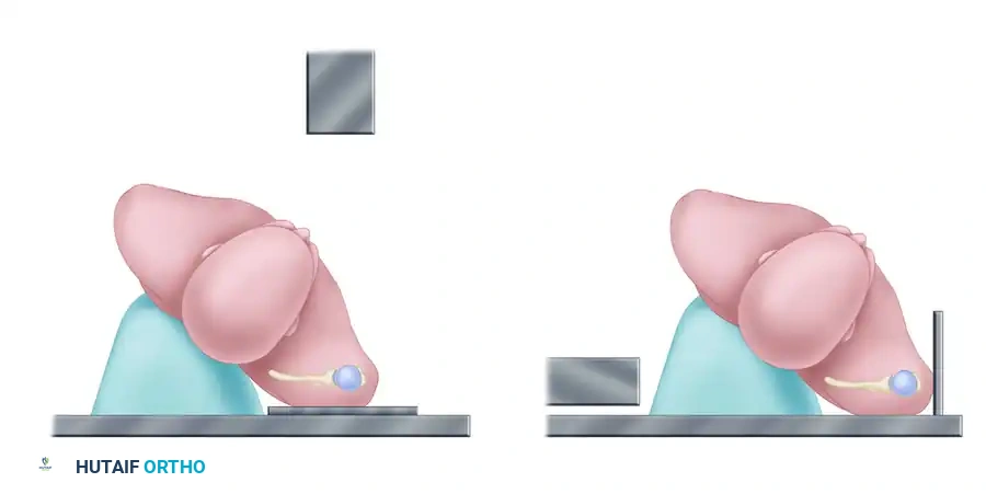 صورة أشعة سينية توضح الرؤية الجانبية لتقييم الإزاحة الأمامية أو الخلفية