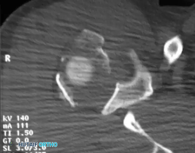 طريقة أخذ صورة الأشعة الإبطية الدقيقة لمفصل الكتف