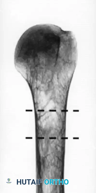 صورة أشعة لمريض يعاني من هشاشة عظام شديدة وقشرة عظمية رقيقة