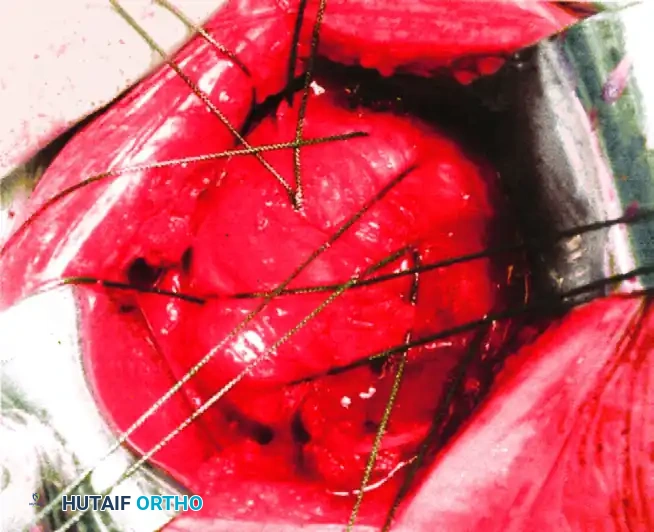 تجهيز المريض والتوجيه الإشعاعي لإدخال الدبابيس عبر الجلد