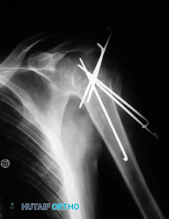 إدخال المسامير العلوية لربط وتثبيت رأس عظمة العضد بالمسمار النخاعي