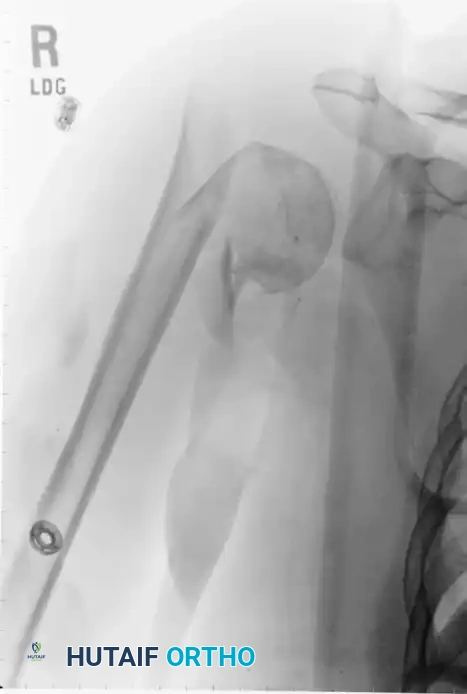 صورة أشعة متقدمة توضح التئام العظام بعد العملية الجراحية