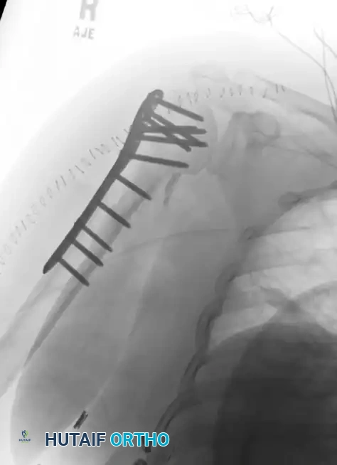 رسم توضيحي لعملية تثبيت عظمة العضد بالشرائح المعدنية