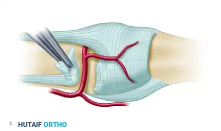 PROXIMAL INTERPHALANGEAL JOINT CAPSULOTOMY Surgical Diagram