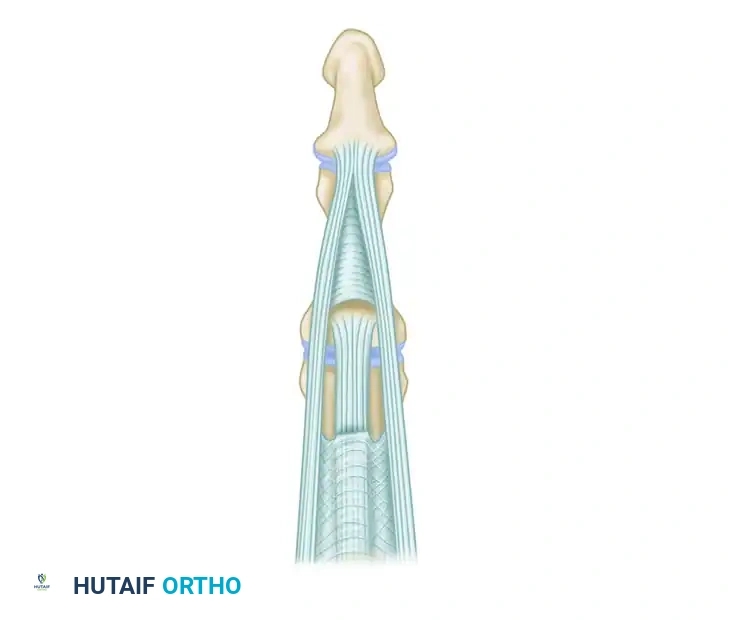 PROXIMAL INTERPHALANGEAL JOINT ARTHROPLASTY THROUGH A DORSAL APPROACH Surgical Diagram