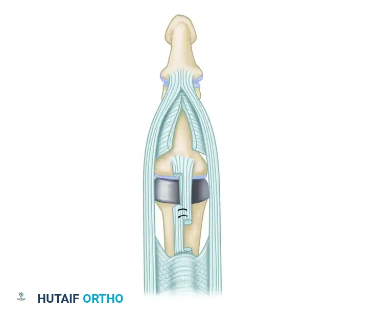 PROXIMAL INTERPHALANGEAL JOINT ARTHROPLASTY THROUGH A DORSAL APPROACH Surgical Diagram