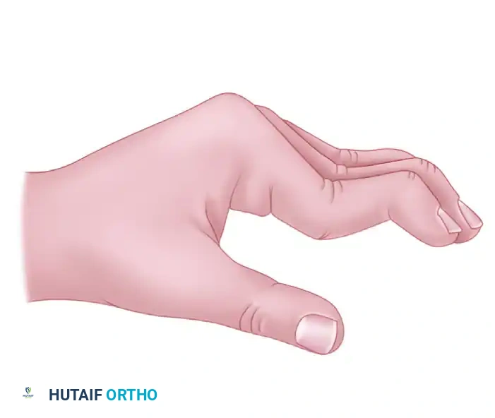 Proximal Interphalangeal Joint Arthroplasty: Comprehensive Surgical Techniques