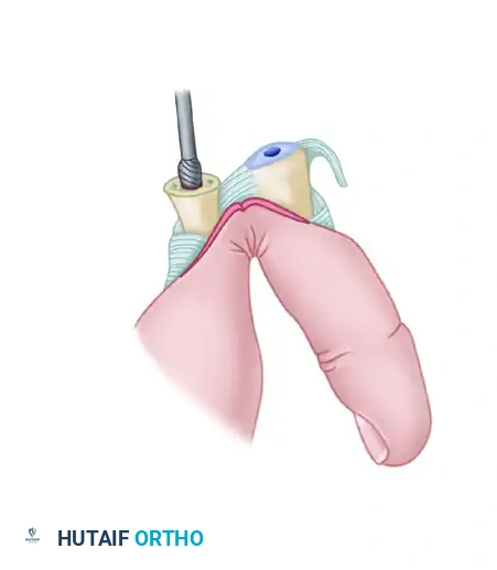 PROXIMAL INTERPHALANGEAL JOINT ARTHROPLASTY THROUGH A DORSAL APPROACH Surgical Diagram