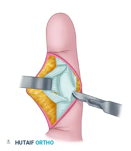 PROXIMAL INTERPHALANGEAL JOINT ARTHROPLASTY THROUGH A DORSAL APPROACH Surgical Diagram