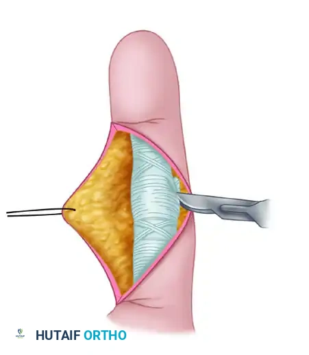 PROXIMAL INTERPHALANGEAL JOINT ARTHROPLASTY THROUGH A DORSAL APPROACH Surgical Diagram