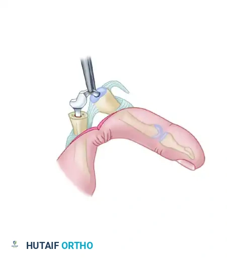 PROXIMAL INTERPHALANGEAL JOINT ARTHROPLASTY THROUGH A DORSAL APPROACH Surgical Diagram