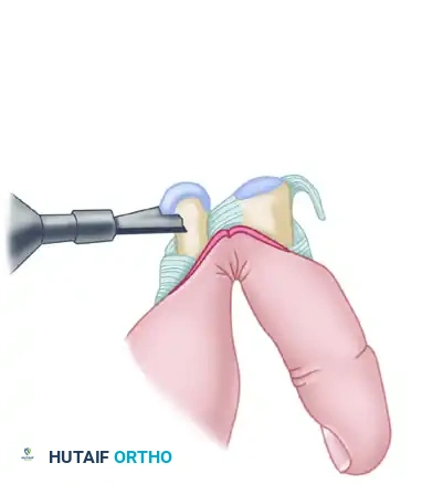 PROXIMAL INTERPHALANGEAL JOINT ARTHROPLASTY THROUGH A DORSAL APPROACH Surgical Diagram