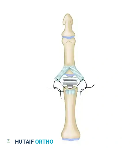 PROXIMAL INTERPHALANGEAL JOINT ARTHROPLASTY THROUGH A DORSAL APPROACH Surgical Diagram