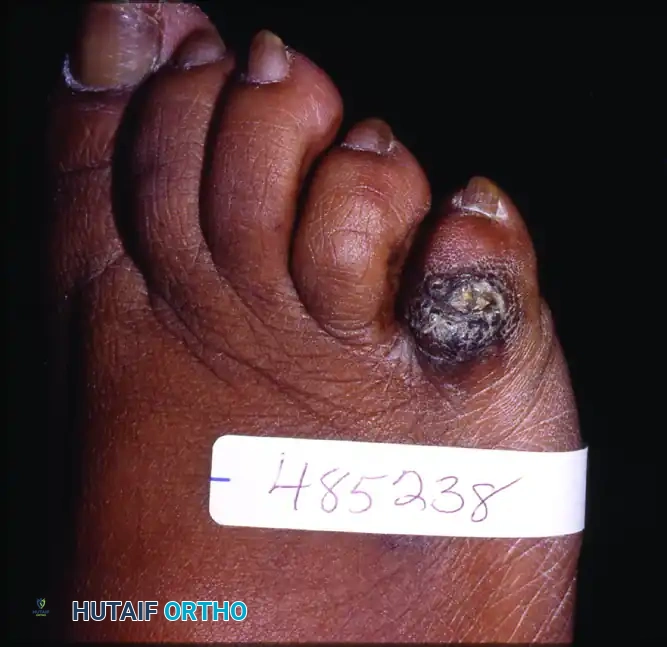 Acutely inflamed hard corn over dorsolateral surface of fifth toe with swelling, heat, and erythema