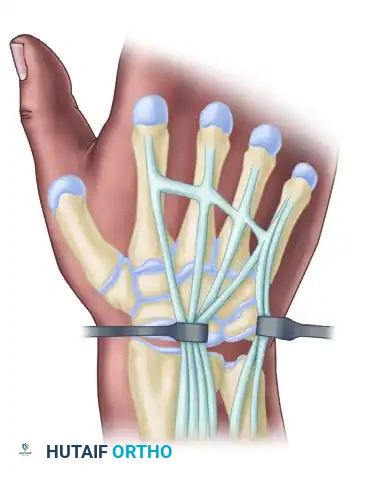 استئصال العظم الهرمي من الرسغ
