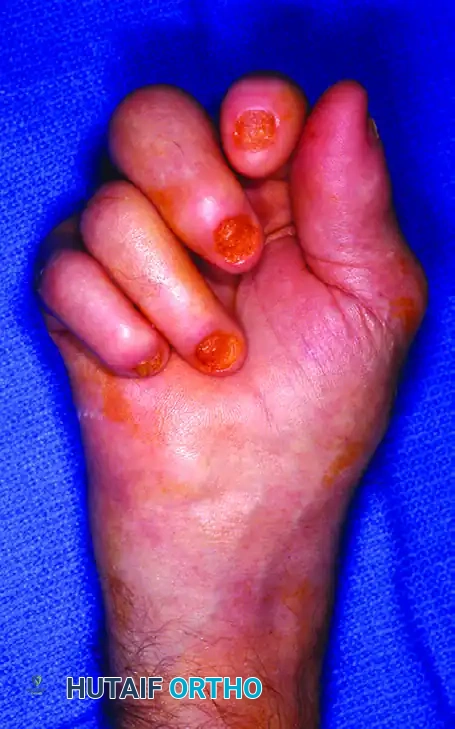 Surgical Management of Psoriatic and Crystal-Induced Arthropathies of the Hand