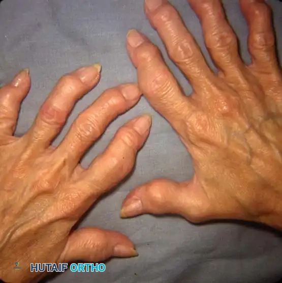 Surgical Management of Psoriatic Arthritis and Reiter Syndrome in the Hand