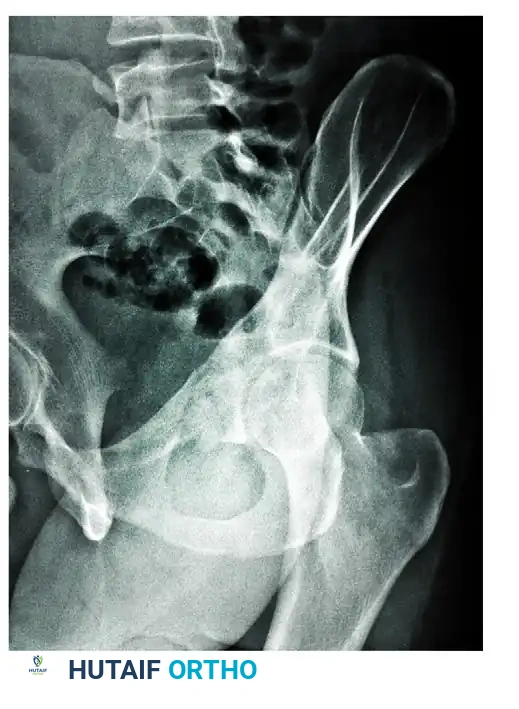 Radiographic Evaluation of Acetabular Fractures: Surgical Guide