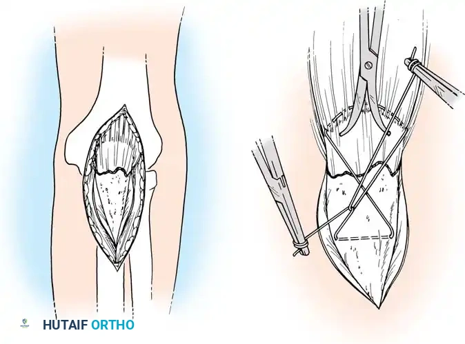 Fig. 54-54 Internal fi xation of olecranon with tension band wire loop.