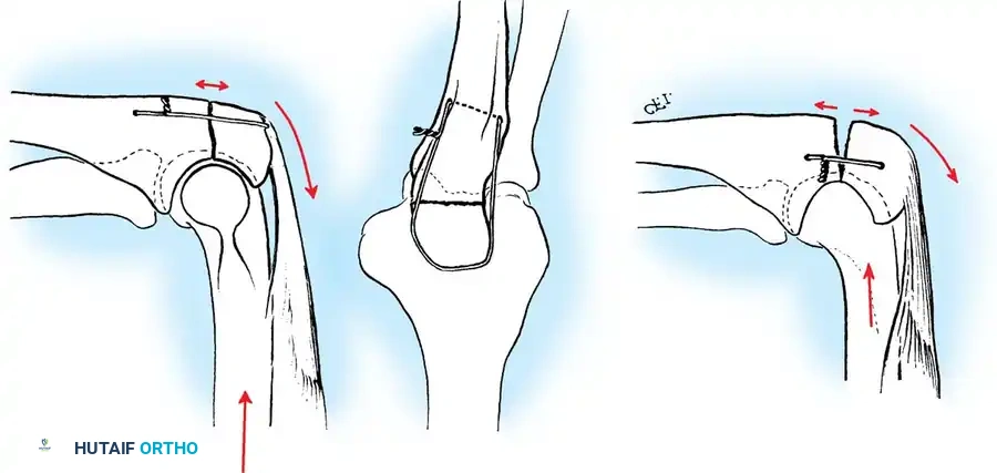 RADIUS AND ULNA Surgical Diagram