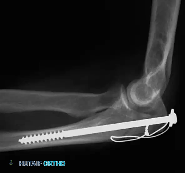 Fig. 54-55 Olecranon fracture repaired with long 6.5-mm AO cancellous screw and fi gure-of-eight tension band wire loop.