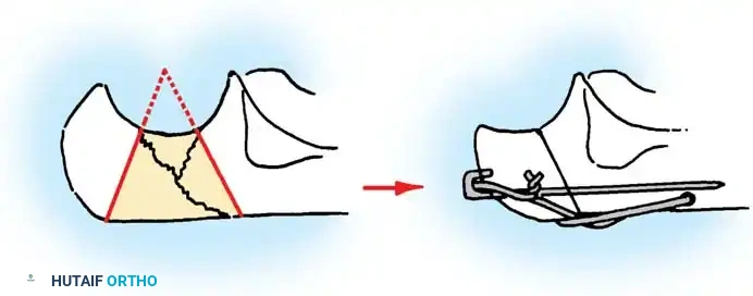 Fig. 54-57 Technique of excision of central one third of olecranon process