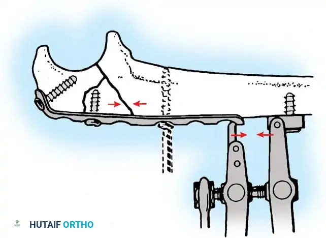 RADIUS AND ULNA Surgical Diagram