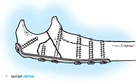 RADIUS AND ULNA Surgical Diagram