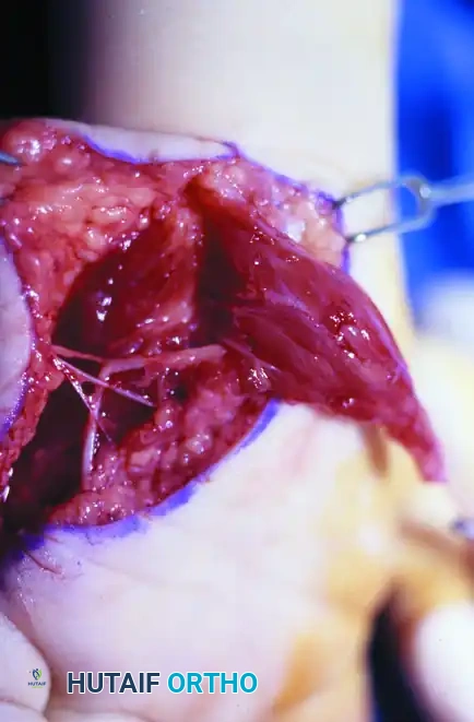 Intraoperative Huber Opponensplasty