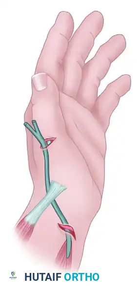 Littler Technique Path